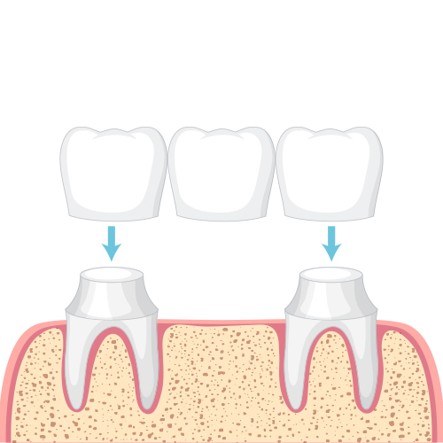 Crowns and Bridges