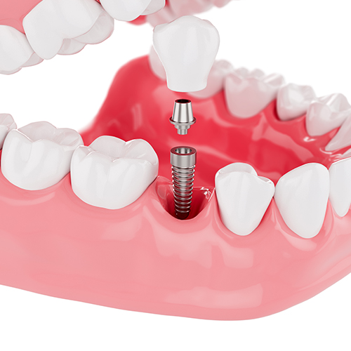 Computer based planning and guided implant