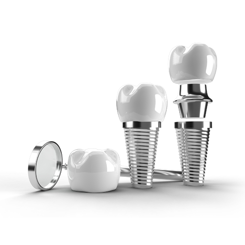 Dental implants